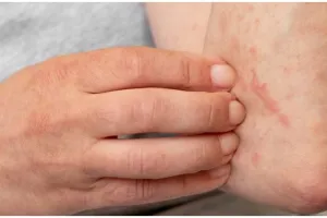 Trik redakan rasa gatal akibat kurap hanya pakai 1 daun tanaman liar ini bikin kulit jadi tenang