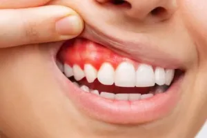 Nggak perlu scalling, begini trik menghilangkan karang gigi membandel pakai 2 jenis rempah