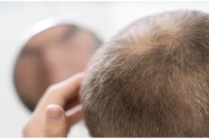 Hanya pakai 1 bumbu masakan, begini trik melebatkan rambut pitak tengah agar kembali tumbuh lebat