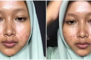 Keajaiban makeup bisa bikin mulus, potret wanita penuh bekas jerawat usai dandan ini bikin susah kedip