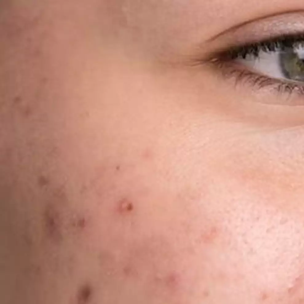 Cara hilangkan pigmentasi akibat penuaan dini ini cuma pakai toner dari 1 buah, bikin kulit glowup