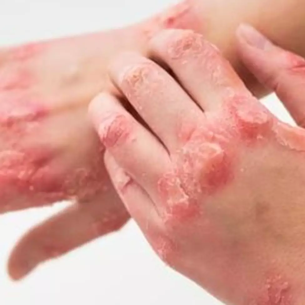 Bukan pakai bawang putih, ini trik mengatasi gatal di sela jari akibat kutu air, pakai 1 bahan makanan