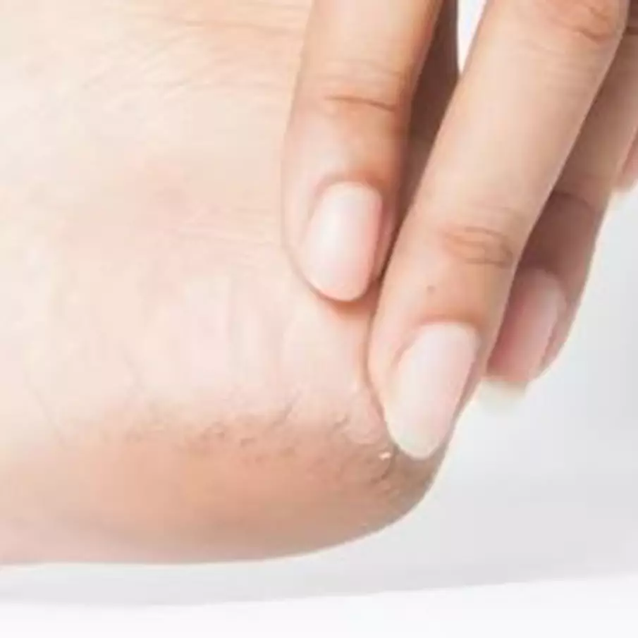 Kulit jadi halus dan mulus, begini trik atasi tumit kaki pecah-pecah dan kering pakai 1 ekstrak buah