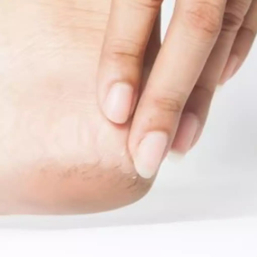 Antikasar dan bebas kapalan, ini trik menghaluskan tumit pecah-pecah pakai 2 jenis minyak