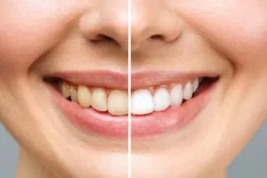 Cara memutihkan gigi kuning akibat karang dan plak ini cuma butuh 1 jenis daun, mulut segar bebas bau