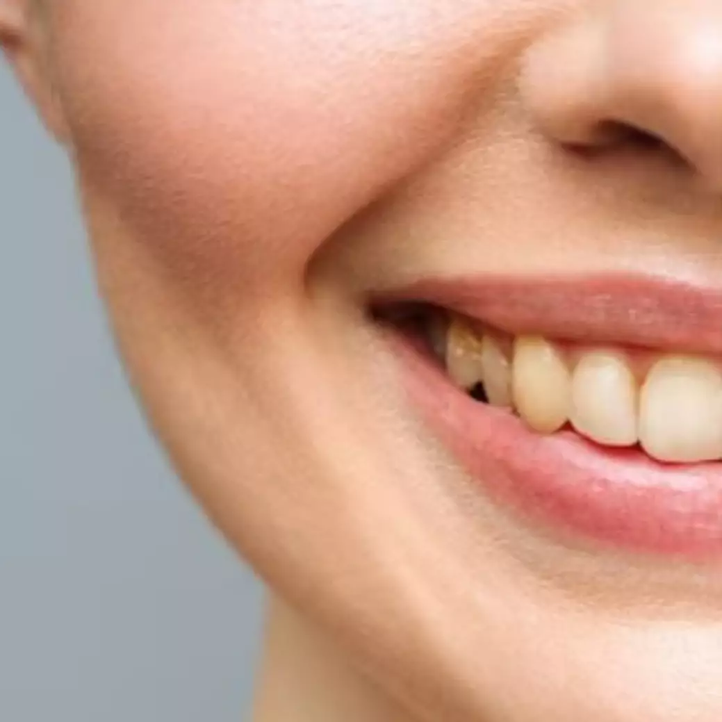 Cara memutihkan gigi kuning akibat karang dan plak ini cuma butuh 1 jenis daun, mulut segar bebas bau