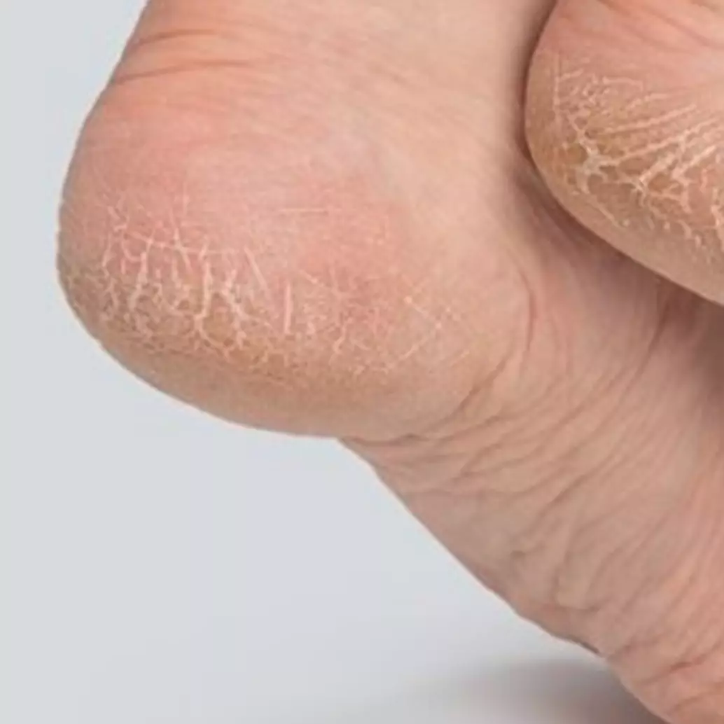Auto kenyal seperti kulit bayi, begini cara atasi tumit pecah-pecah hanya pakai 1 jenis bunga