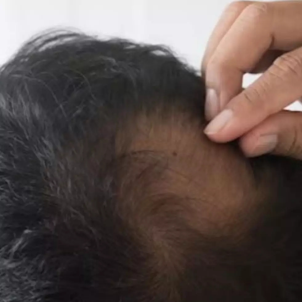 Bukan pakai hair tonic, begini trik menumbuhkan kembali rambut botak pakai 1 jenis biji-bijian
