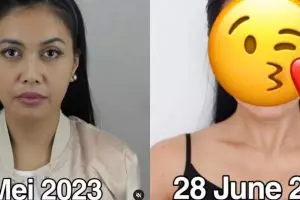 Denada operasi plastik di Korea, hasilnya disebut cantik tak lebay, intip beda sebelum & sesudah oplas