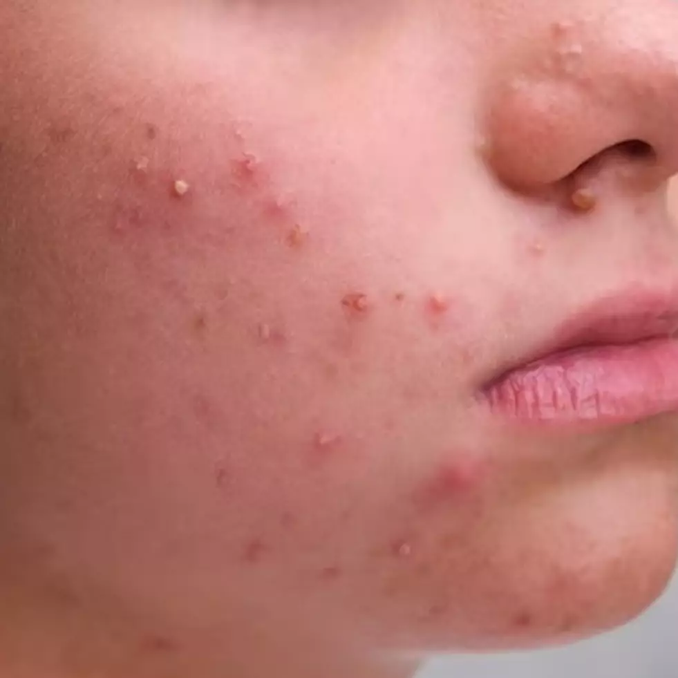 Trik simpel atasi jerawat dengan masker dari 1 jenis buah, hempas bekas dan kemerahan sekaligus