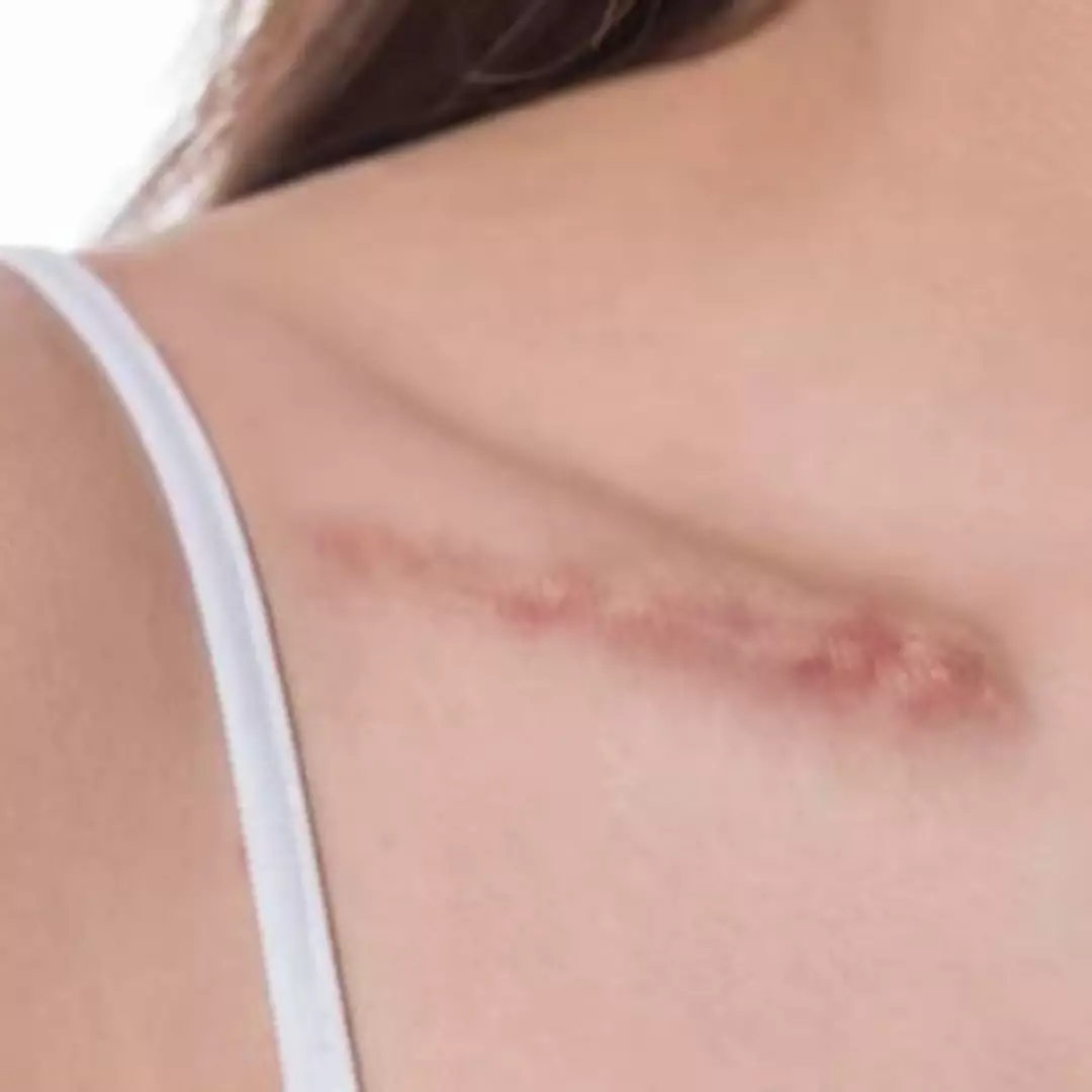 Bikin kulit cerah dan mulus, ini trik menghilangkan bekas luka pakai scrub dari 1 bahan minuman