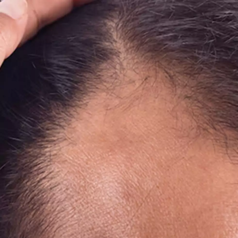 Cara atasi rambut botak di sisi samping pakai sampo dari 1 jenis bunga, bikin tumbuh lebat dan shiny