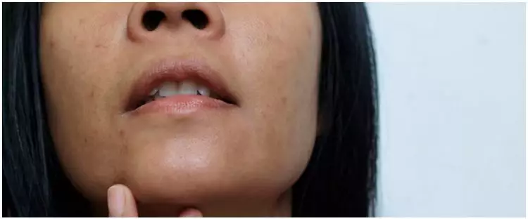 Hempaskan noda, begini trik menghilangkan flek hitam hanya pakai 1 jenis kulit buah