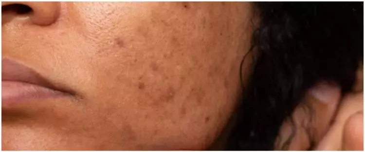 Wajah bebas noda, begini trik menghilangkan flek dan bintik hitam hanya pakai 1 jenis buah