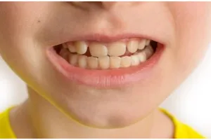 Senyum tampak glowing, begini trik cerahkan gigi kuning akibat pewarna makanan pakai 3 bahan rempah