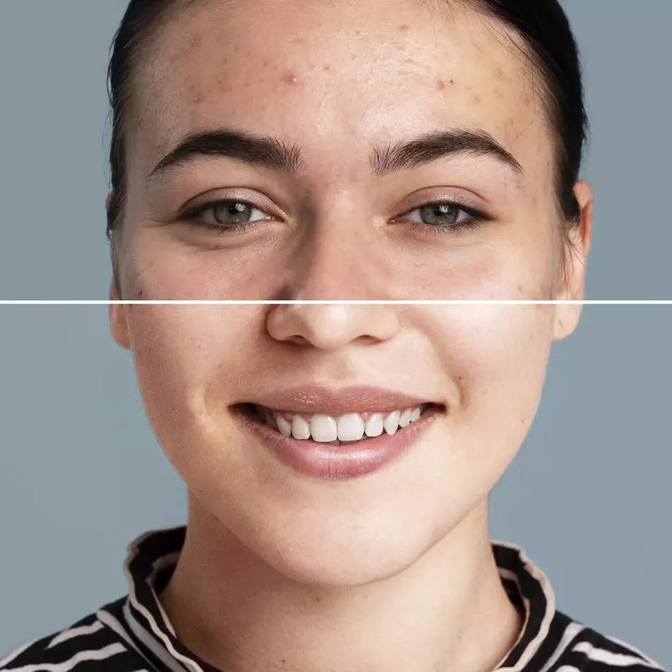 Tak ada lagi noda di wajah, ini trik hilangkan pigmentasi hanya pakai krim antiaging dari 1 jenis buah