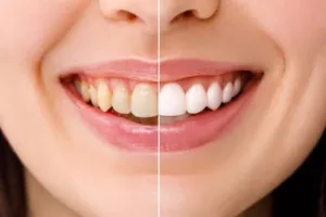 Hempas plak dan noda, ini trik memutihkan gigi kuning pakai ramuan dari 1 bahan pewarna alami