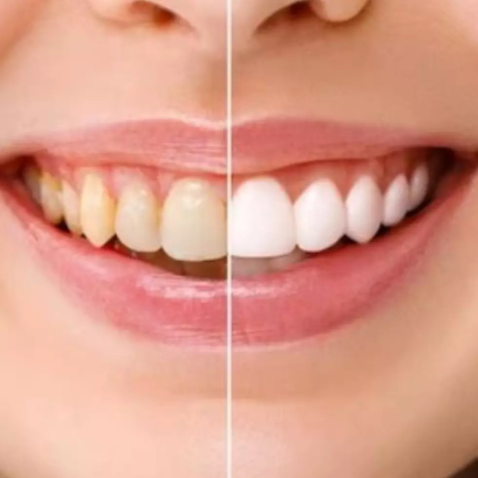 Hempas plak dan noda, ini trik memutihkan gigi kuning pakai ramuan dari 1 bahan pewarna alami