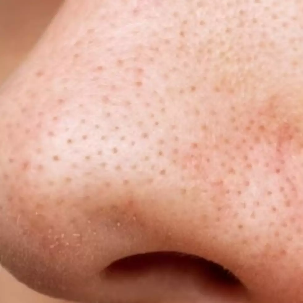 Tak perlu pakai pore pack, ini trik kecilkan pori-pori wajah untuk cegah komedo pakai 2 bahan minuman