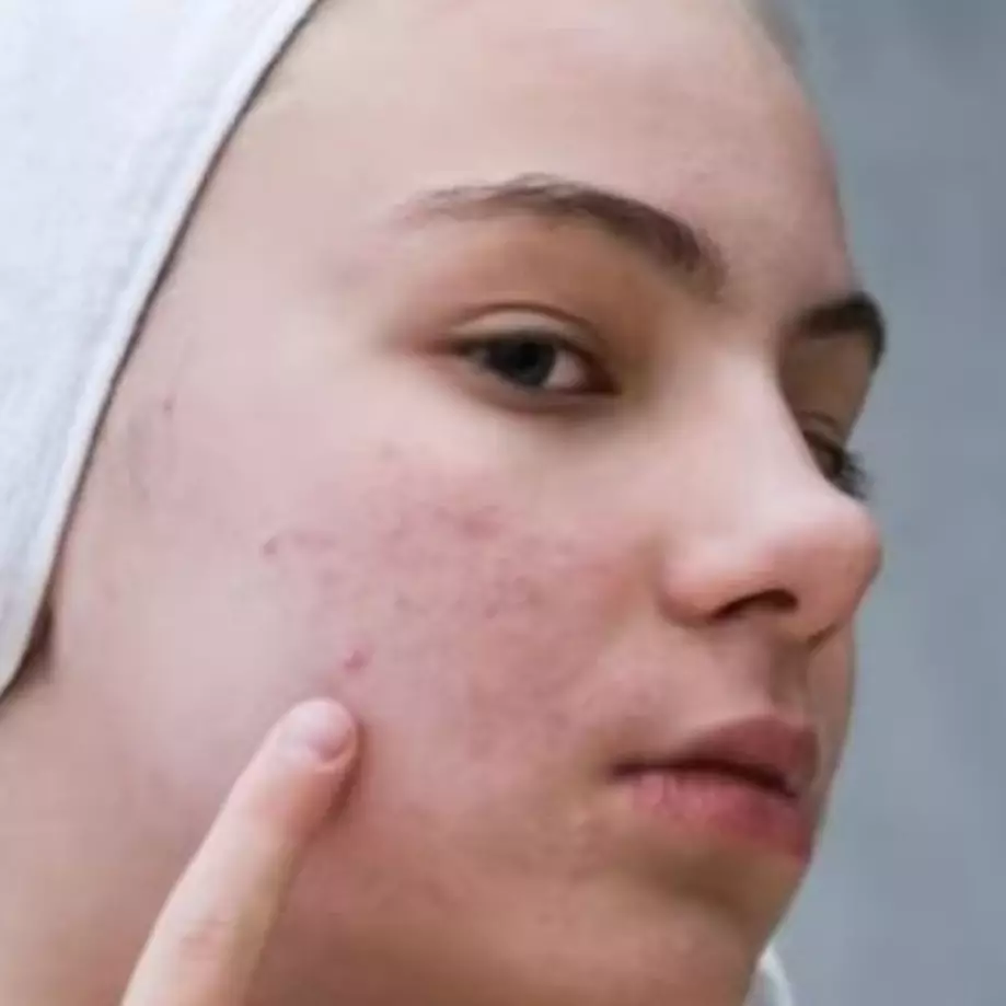 Bersih optimal bak pakai face wash pasaran, ini cara membuat acne cleansing dari 1 bahan pemanis