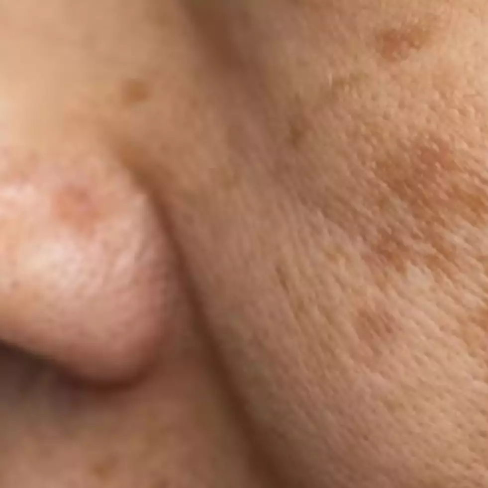 Hasil terlihat dalam 5 menit, ini trik atasi noda hiperpigmentasi wajah pakai 1 jenis umbi-umbian