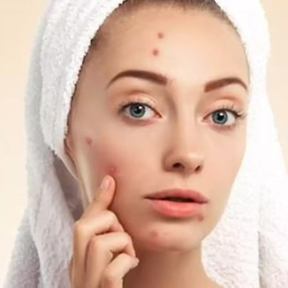 Bantu hempaskan jerawat meradang, begini cara membuat night serum hanya pakai 1 jenis herbal