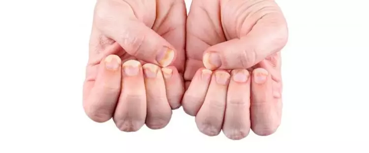 Cara mudah bikin kuku nggak gampang patah pakai 2 jenis minyak, sehat tanpa perlu manicure