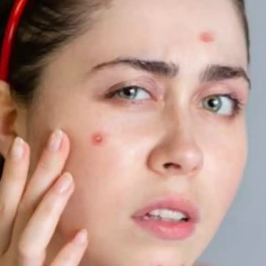 Flawless tanpa komedo dan jerawat, ini cara mengurangi minyak pada wajah pakai 1 sumber protein