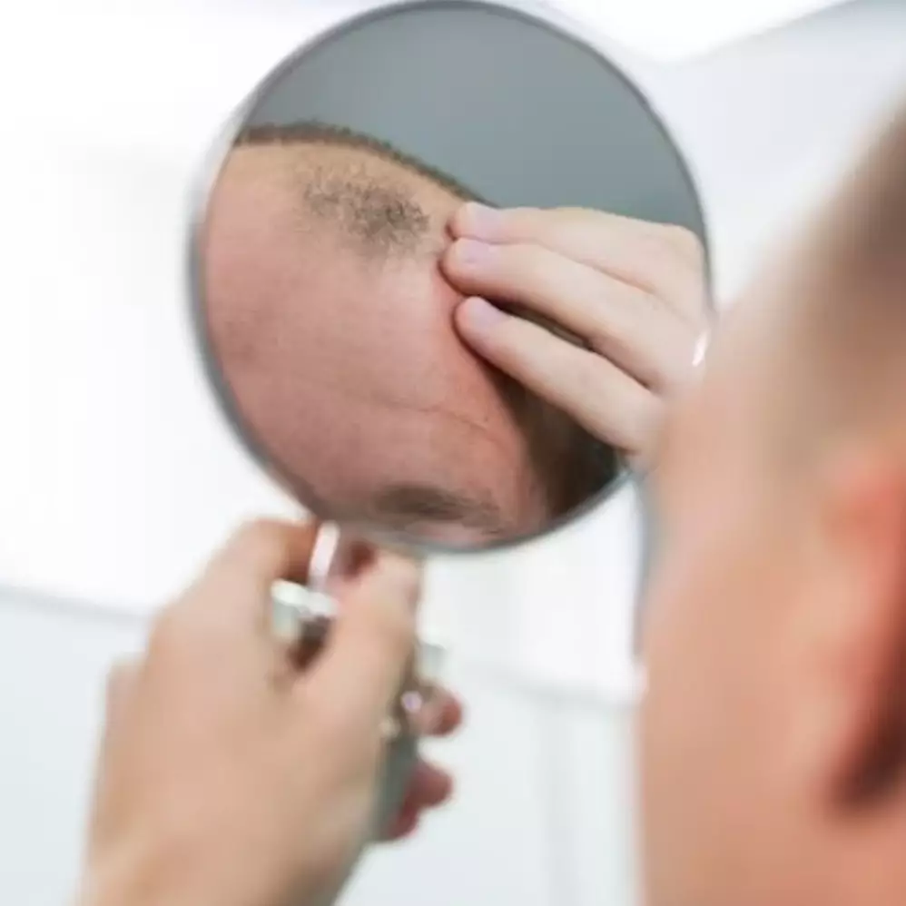 Tumbuh lebat dalam 15 hari, ini cara atasi kebotakan rambut akibat rontok pakai 1 jenis daun