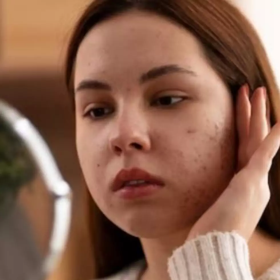 Bukan pakai acne patch, ini cara mengatasi jerawat meradang pakai masker dari 1 bahan pemanis