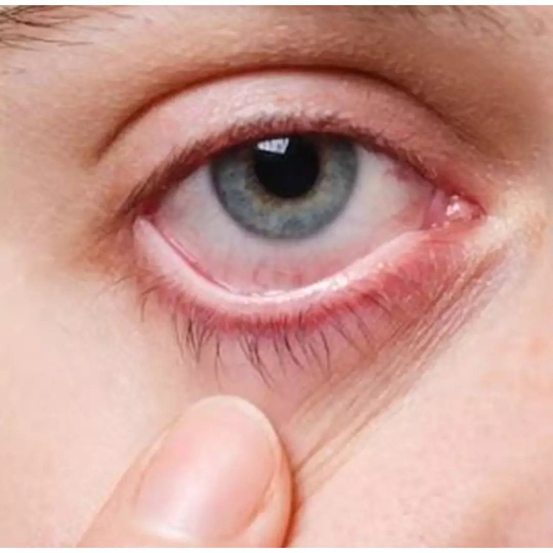 Nggak perlu beli eye serum roll, begini trik atasi mata sembab hanya pakai 1 bahan lalapan