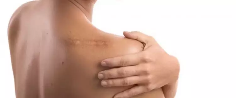 Mulus tanpa noda, ini trik hilangkan bekas luka pakai scrub dari 1 jenis bahan pemanis