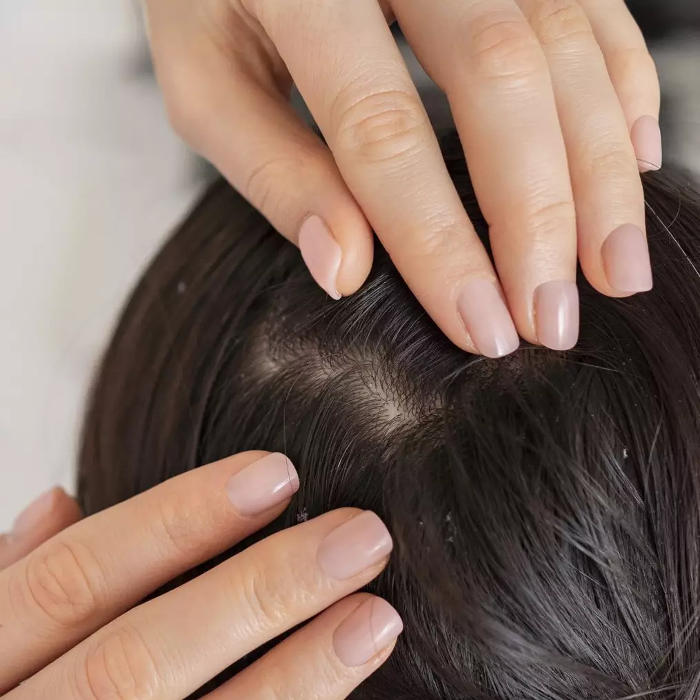 Cara atasi kebotakan akibat peradangan pakai masker dari 1 jenis rempah, bikin rambut kembali lebat