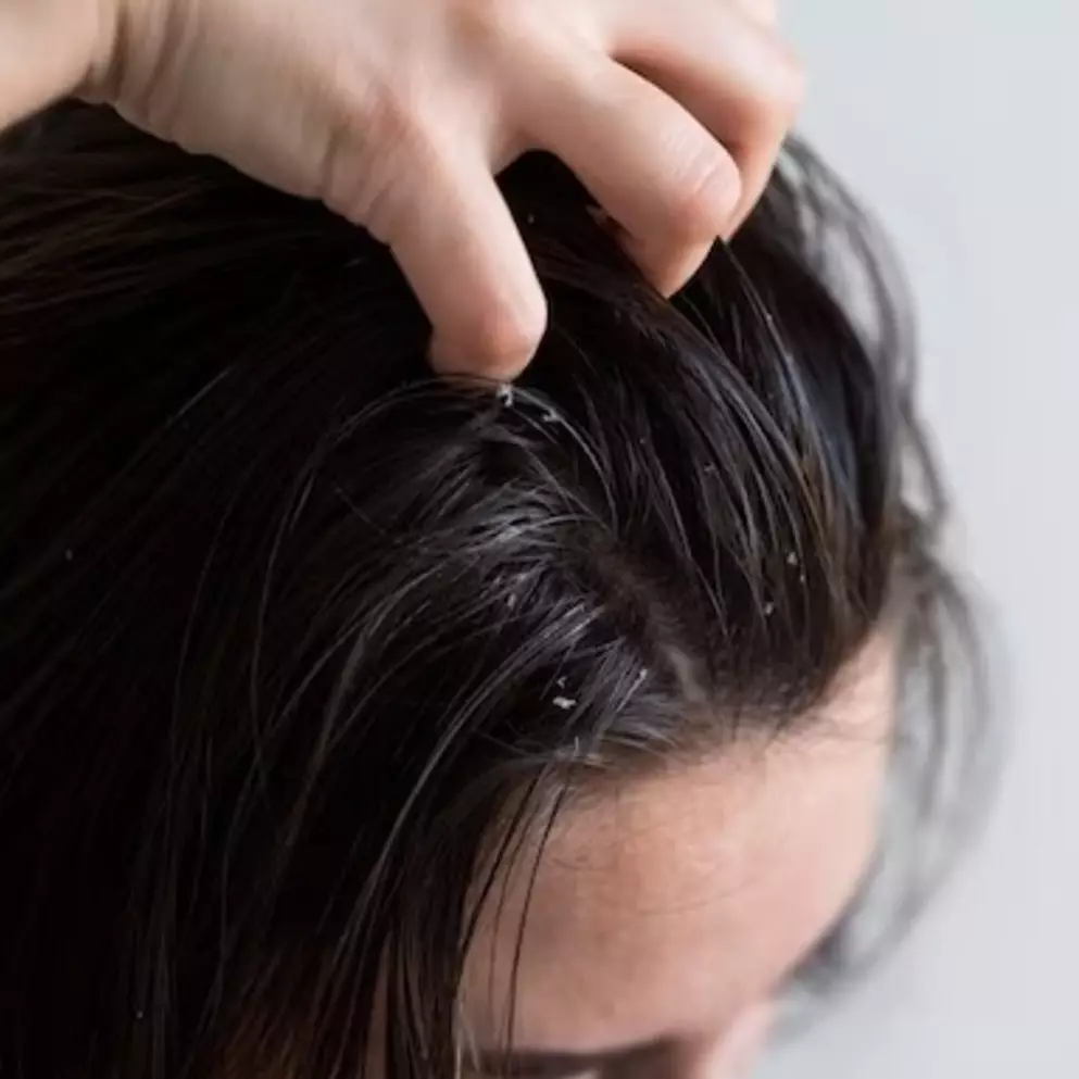 Trik atasi minyak berlebih di kepala pakai 2 jenis bahan makanan, usir rasa greasy di rambut