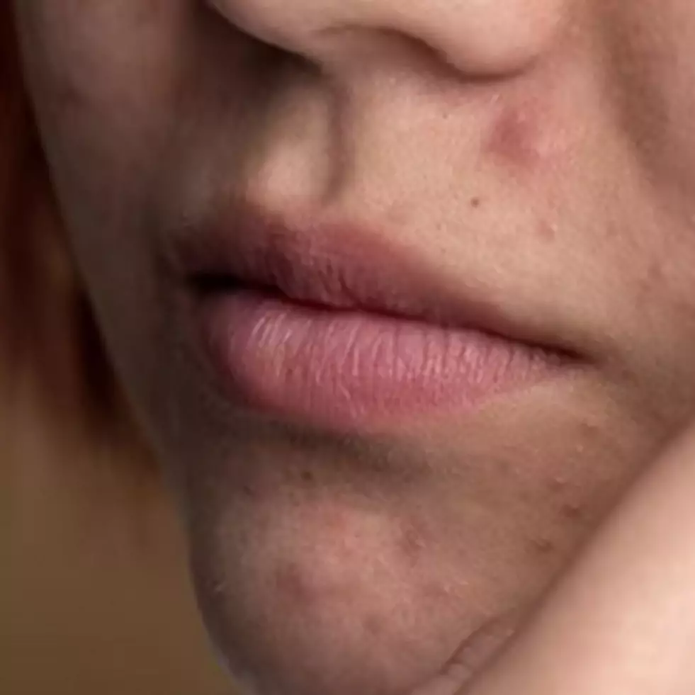 Hilang tanpa bekas, begini trik atasi jerawat meradang hanya pakai 1 jenis karbohidrat