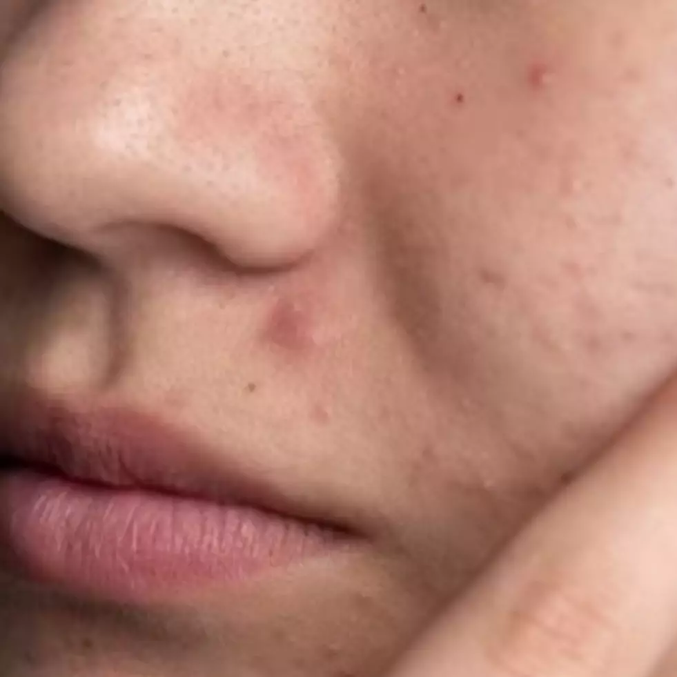 Wajah mulus bebas gradakan, begini cara menghilangkan beruntusan pakai masker dari 1 bahan pemanis