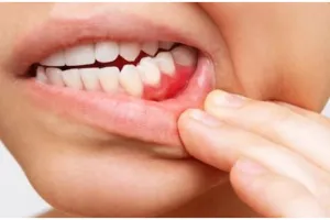 Tanpa jahe, ini cara mudah hilangkan karang gigi agar tak makin parah hanya pakai 1 bahan rempah