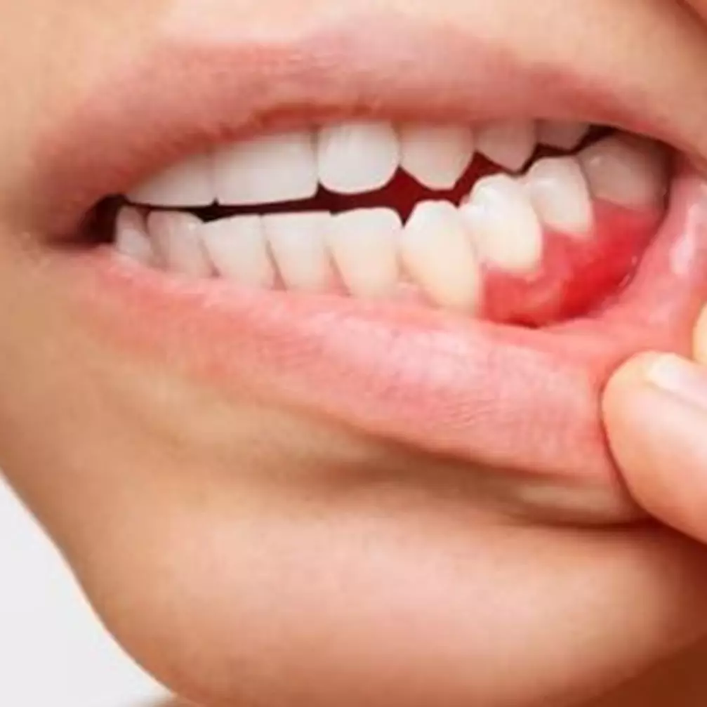 Tanpa jahe, ini cara mudah hilangkan karang gigi agar tak makin parah hanya pakai 1 bahan rempah