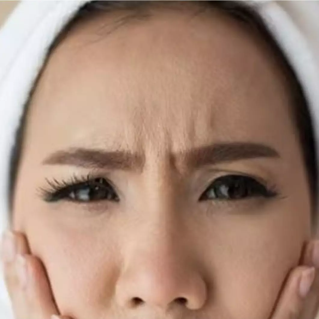 Cara hilangkan garis halus di dahi pakai botoks alami dari 1 jenis minuman, bikin kulit auto kenyal