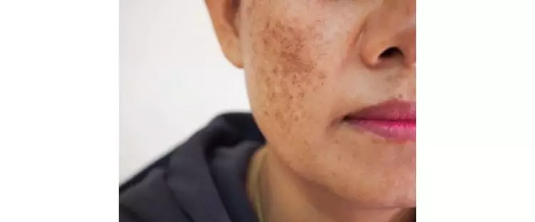 Bikin wajah kinclong merata, ini trik simpel pudarkan spot hitam dan kulit belang pakai 1 jenis buah