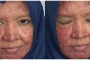 Punya kulit gradakan karena jerawat, wanita ini dirias MUA jadi manten Sunda manglingi berwajah mulus