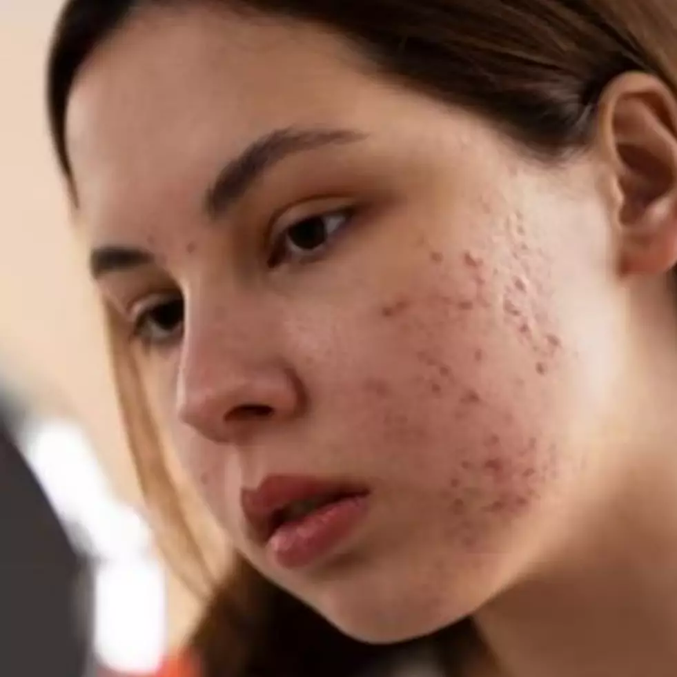 Nggak perlu krim antiacne, begini trik atasi jerawat dan beruntusan pakai masker dari 1 jenis tepung