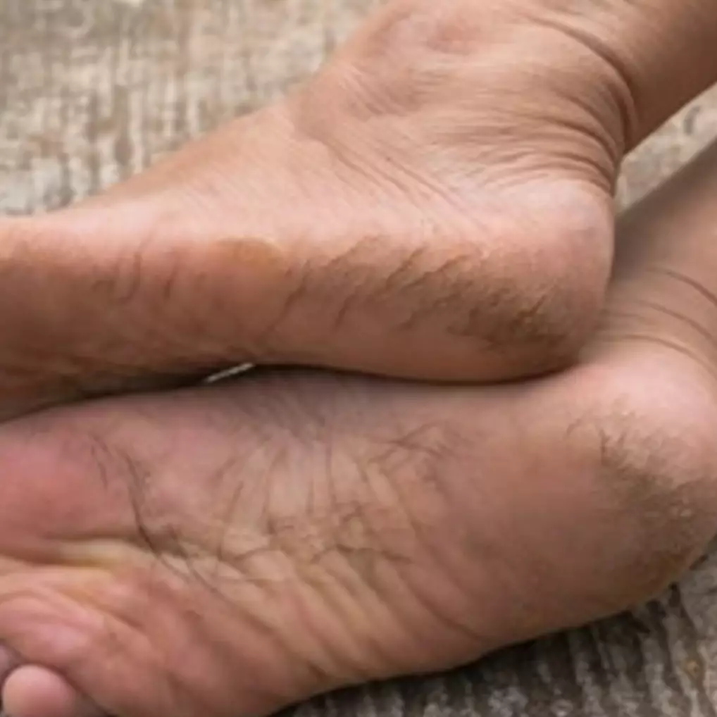 Nggak pakai getah labu siam, ini trik membuat tumit retak kembali mulus pakai 1 jenis minyak