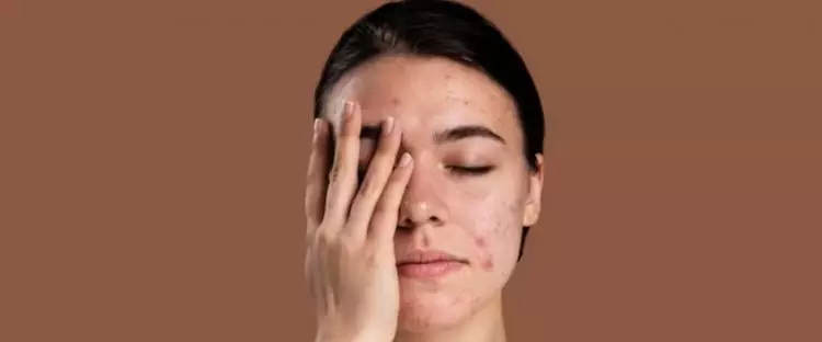 Tak kalah efektif dari kunyit, ini trik mengatasi jerawat dan bekasnya pakai masker dari 1 jenis daun