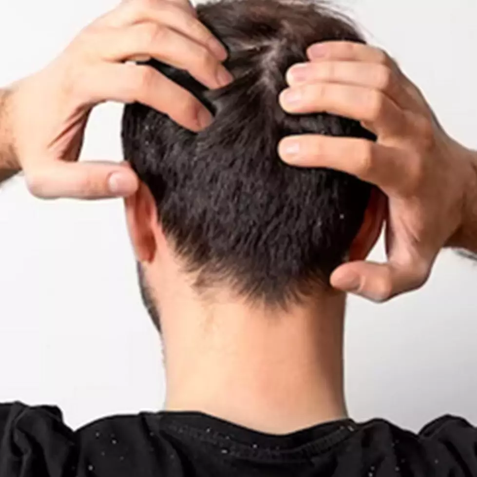 Tanpa perlu cuka apel, ini cara atasi ketombe dan gatal berlebih pakai sampo dari 1 jenis karbohidrat