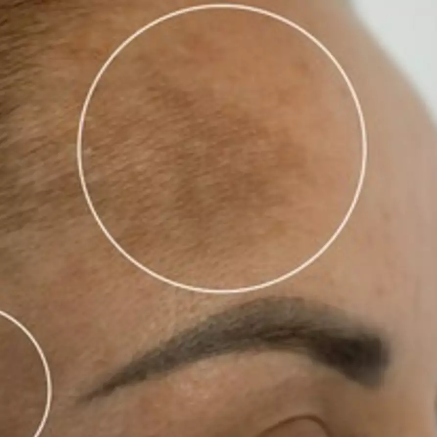 Nggak pakai lemon, ini cara pudarkan pigmentasi di dahi dan garis senyum pakai 1 jenis kulit buah