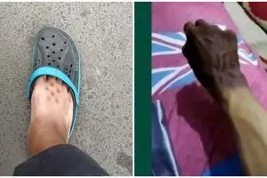 11 Potret kocak kulit belang karena panas-panasan ini bikin nyesel nggak pakai sunblock ke luar rumah