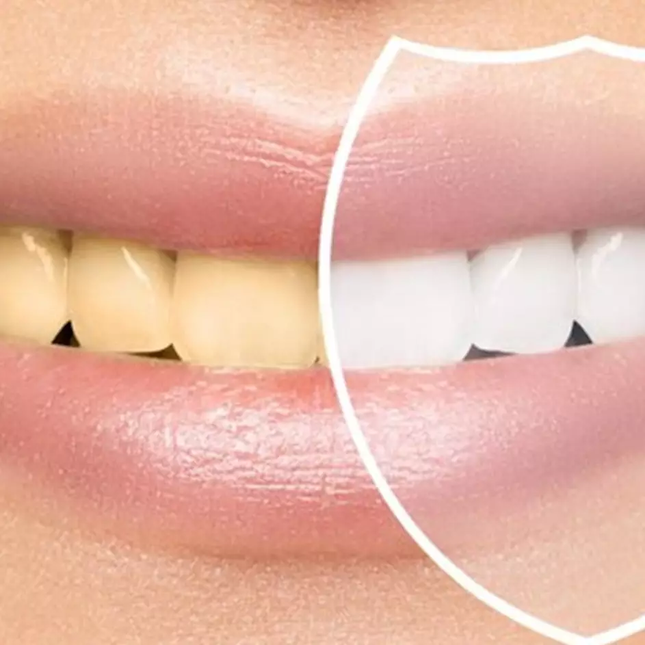 Tanpa scaling di dokter, ini trik hilangkan plak di gigi hanya pakai 3 bahan alami