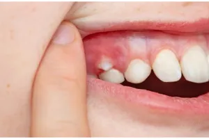 Aksi wanita tunjukkan cara membuat gigi gingsul buatan sendiri, hasilnya tampak natural