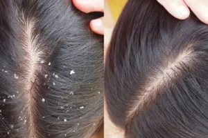 Tak cukup sampo dan kondisioner, ini trik usir ketombe di rambut pakai 2 jenis minyak